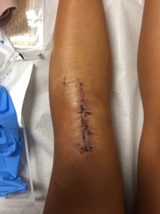 ACL Scar